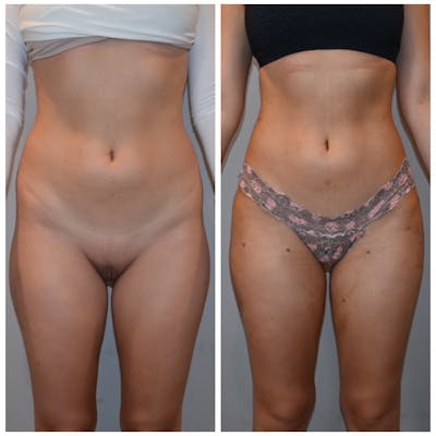 Liposuction Before & After Photos - Patient 146287139 - Image 2