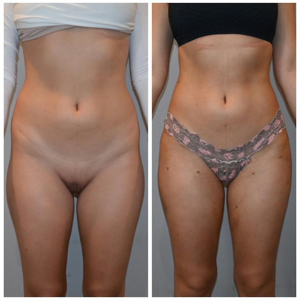Liposuction Before & After Gallery - Patient 146287139 - Image 2