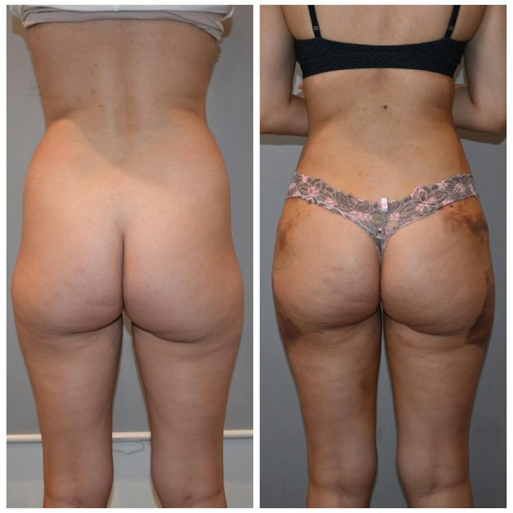 Liposuction Before & After Photos - Patient 146287139 - Image 1
