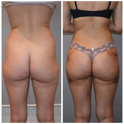 Liposuction Before & After Photos - Patient 146287139 - Image 1