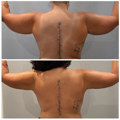 Arm Liposuction Before & After Photos - Patient 321631 - Image 1