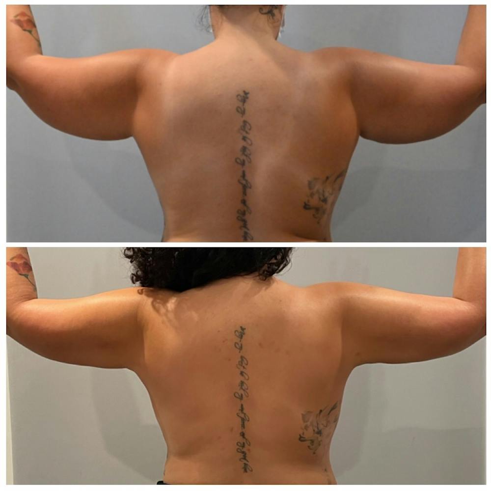 Arm Liposuction Before & After Gallery - Patient 321631 - Image 1
