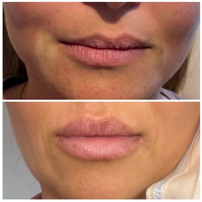 Lip Fillers Before & After Photos - Patient 146287142 - Image 1