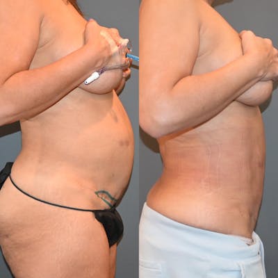 Tummy Tuck (Abdominoplasty) Before & After Photos - Patient 146287144 - Image 1