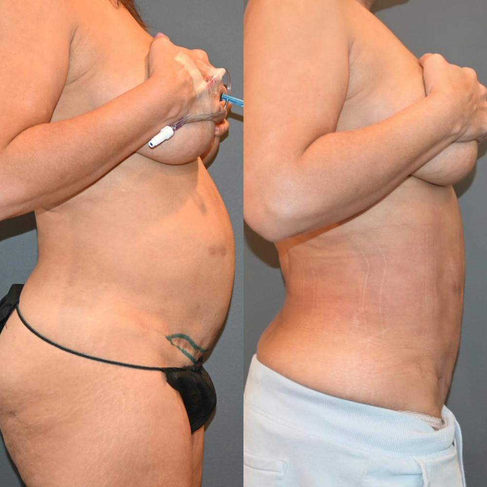 Tummy Tuck (Abdominoplasty) Before & After Gallery - Patient 146287144 - Image 1