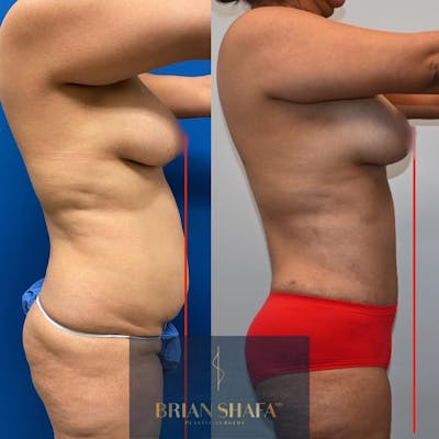 Liposuction Before & After Gallery - Patient 146287147 - Image 1