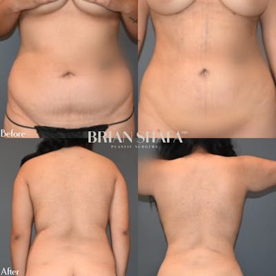Liposuction Before & After Photos - Patient 146287148 - Image 1