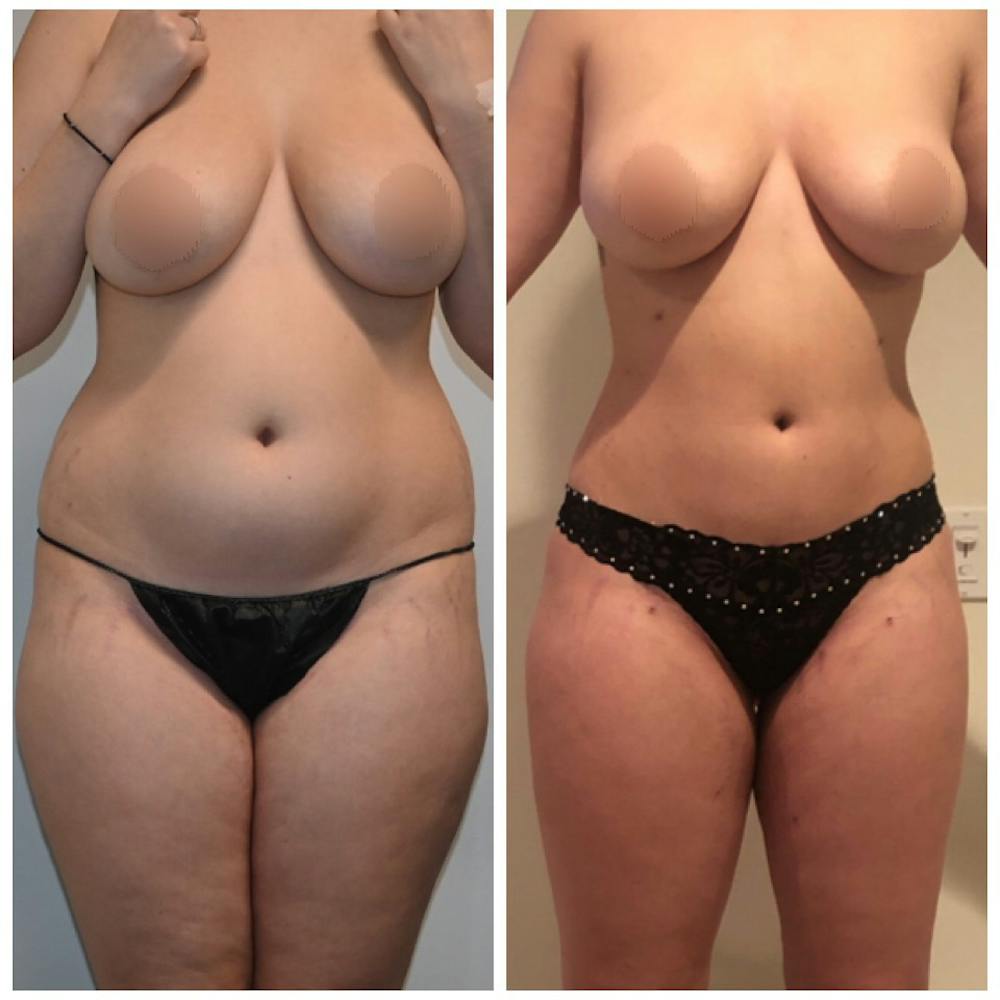 Liposuction Before & After Gallery - Patient 146287149 - Image 1