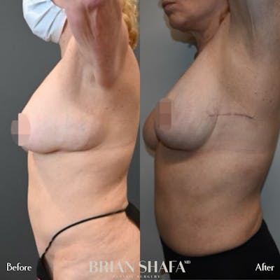 Lipoma Removal Before & After Photos - Patient 146287153 - Image 1