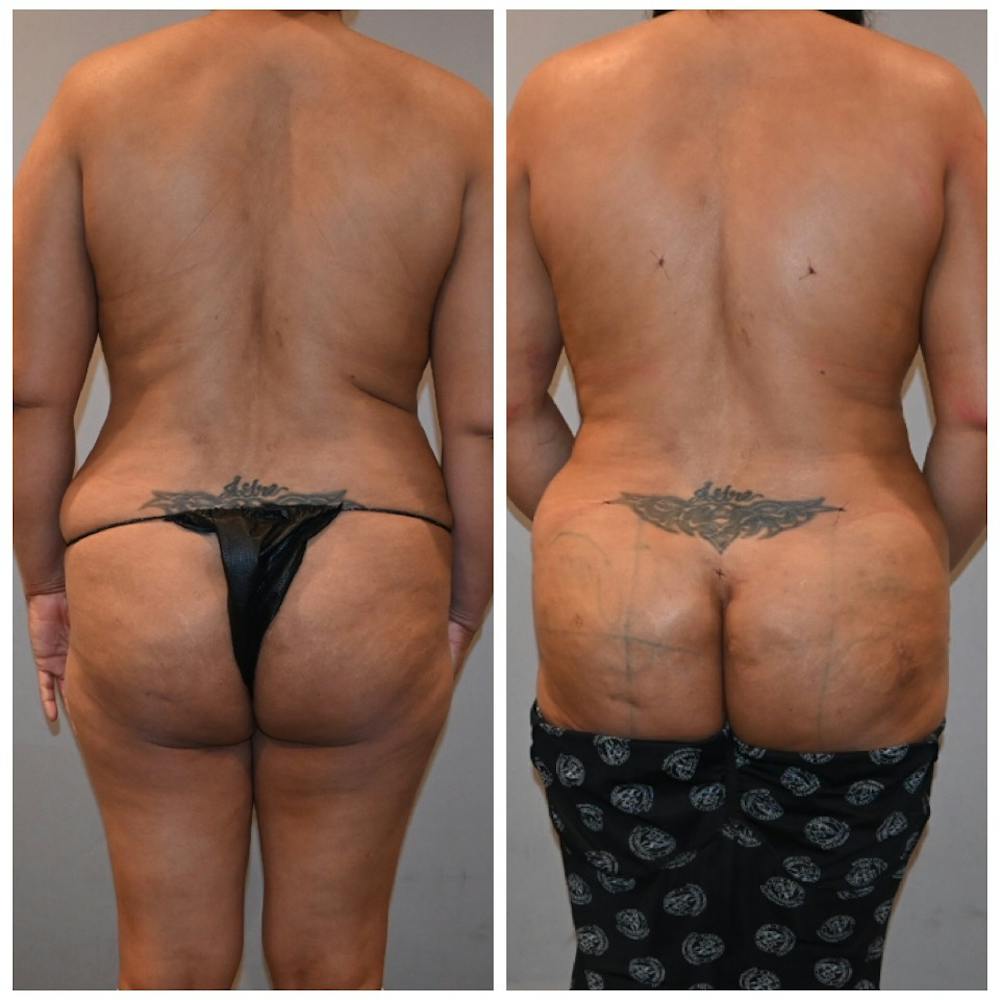 Liposuction Before & After Photos - Patient 146287177 - Image 1