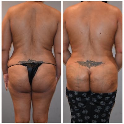 Liposuction Before & After Gallery - Patient 146287177 - Image 1