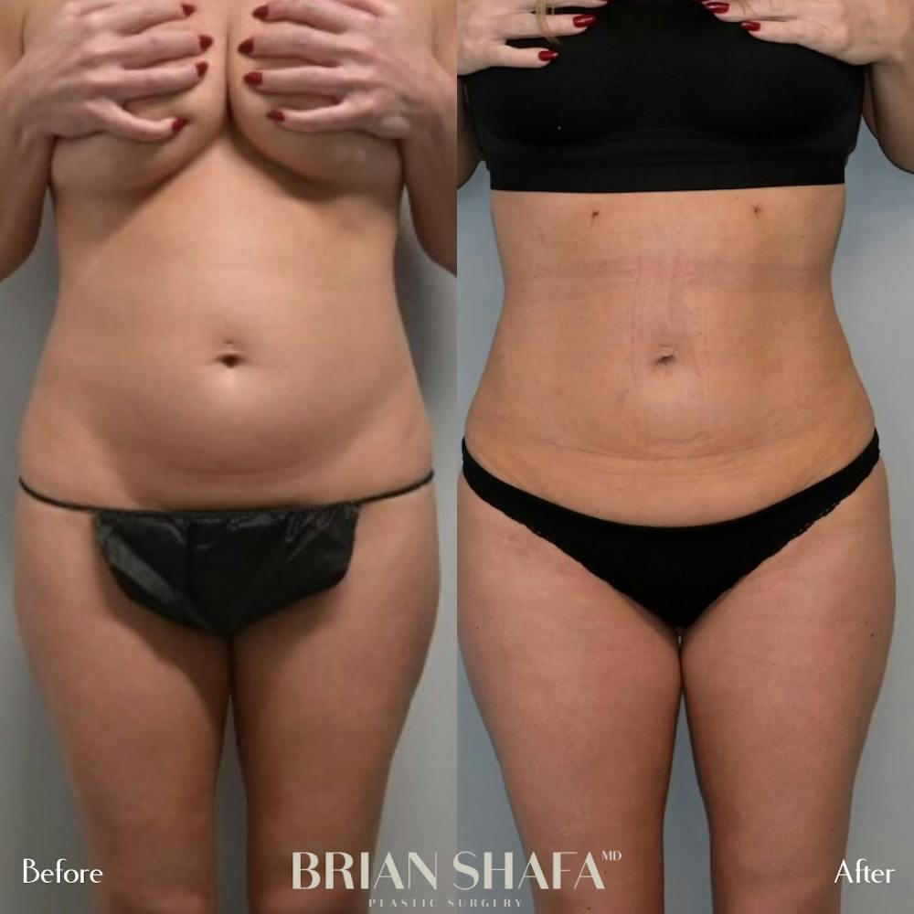 High-Def Liposuction  Before & After Gallery - Patient 146287180 - Image 1