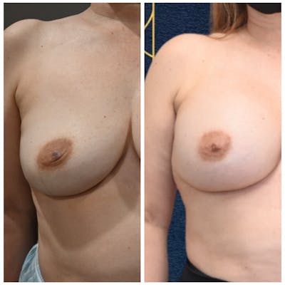 Breast Augmentation  Before & After Photos - Patient 146287183 - Image 1