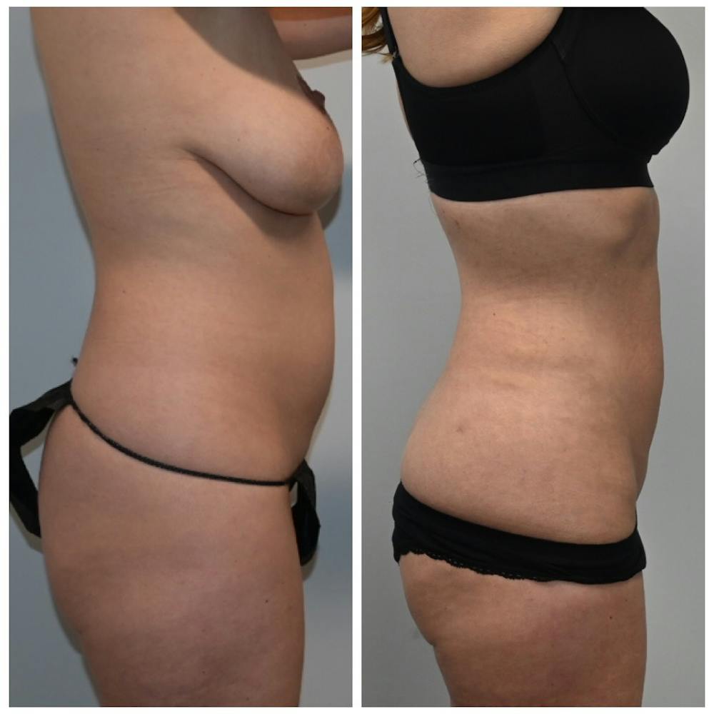 High-Def Liposuction  Before & After Gallery - Patient 146287180 - Image 2