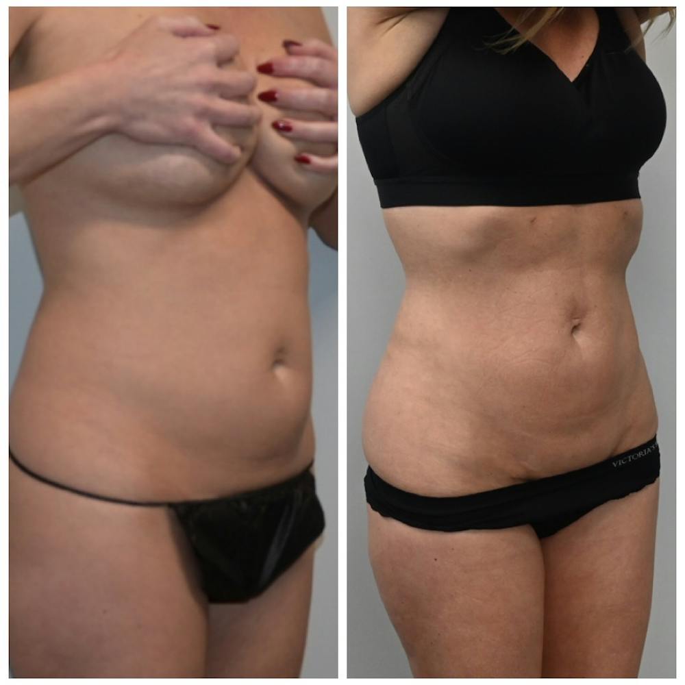 High-Def Liposuction  Before & After Gallery - Patient 146287180 - Image 3