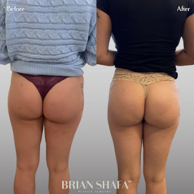 Non-Surgical BBL Before & After Gallery - Patient 146287188 - Image 1
