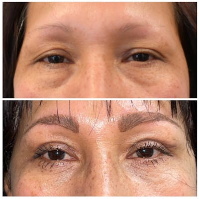 Eyelid Surgery Before & After Photos - Patient 146287181 - Image 1