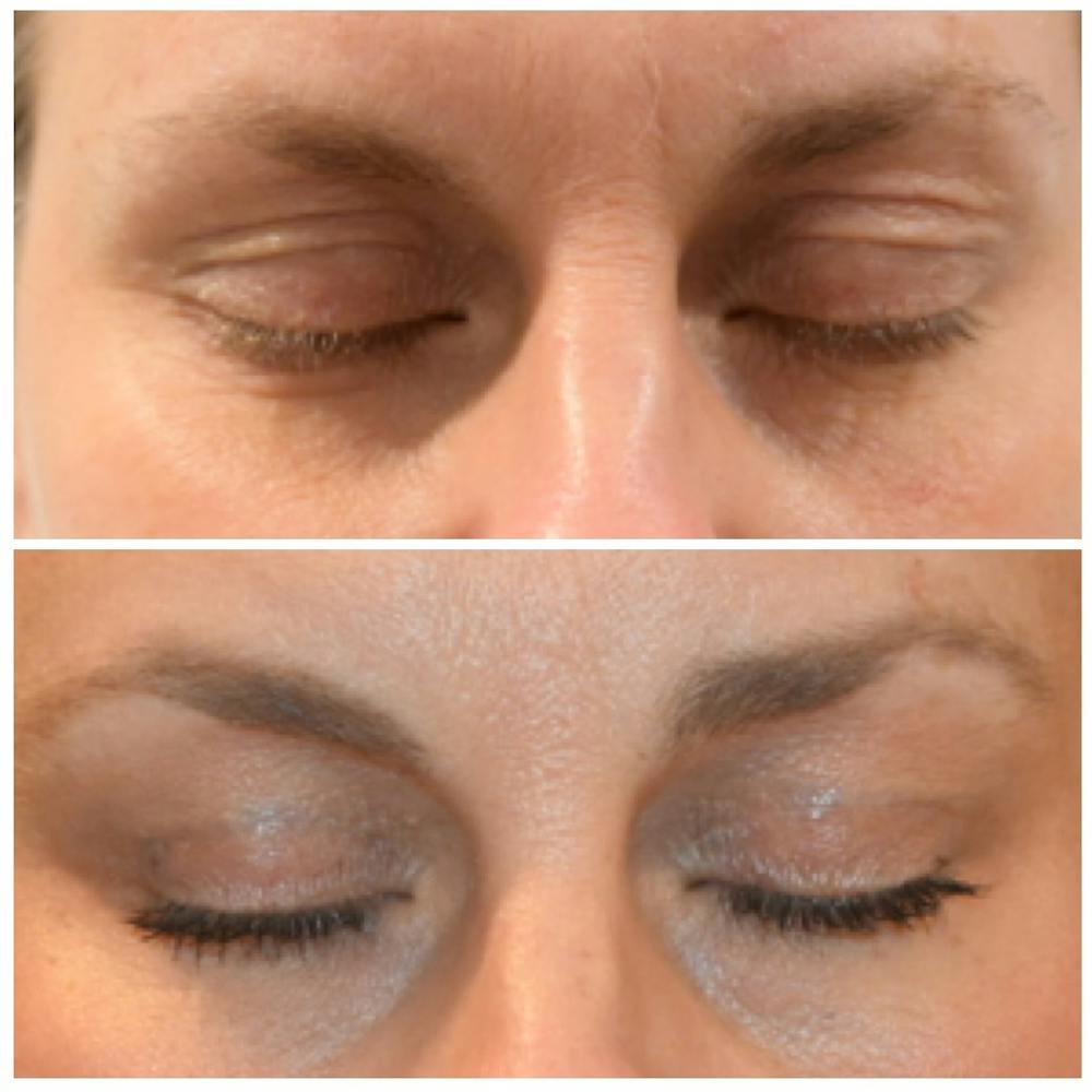 Eyelid Surgery Before & After Gallery - Patient 146287192 - Image 2