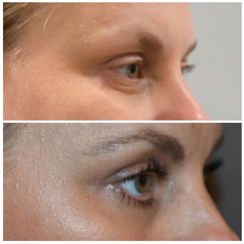 Eyelid Surgery Before & After Gallery - Patient 146287192 - Image 3