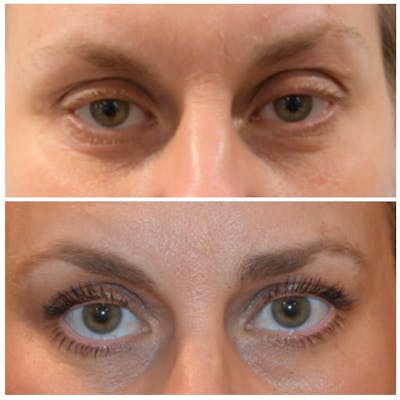 Eyelid Surgery Before & After Photos - Patient 146287192 - Image 1