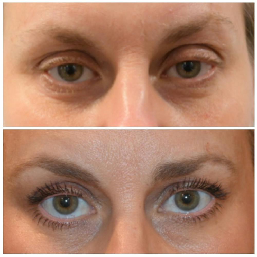 Eyelid Surgery Before & After Gallery - Patient 146287192 - Image 1