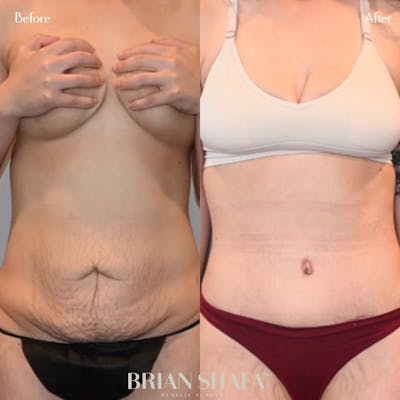 Tummy Tuck (Abdominoplasty) Before & After Photos - Patient 146287195 - Image 1