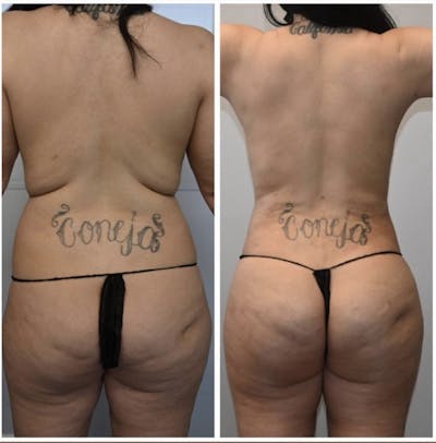 Liposuction Before & After Photos - Patient 146287196 - Image 1