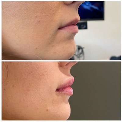 Lip Fillers Before & After Gallery - Patient 146287191 - Image 2