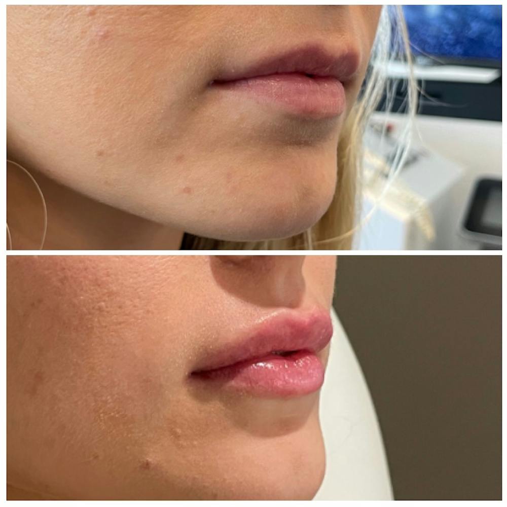 Lip Fillers Before & After Gallery - Patient 146287191 - Image 3