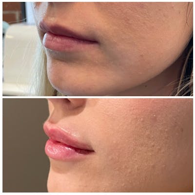 Lip Fillers Before & After Gallery - Patient 146287191 - Image 4