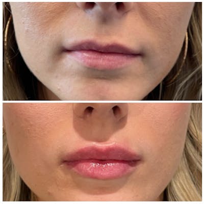 Lip Fillers Before & After Photos - Patient 146287191 - Image 1