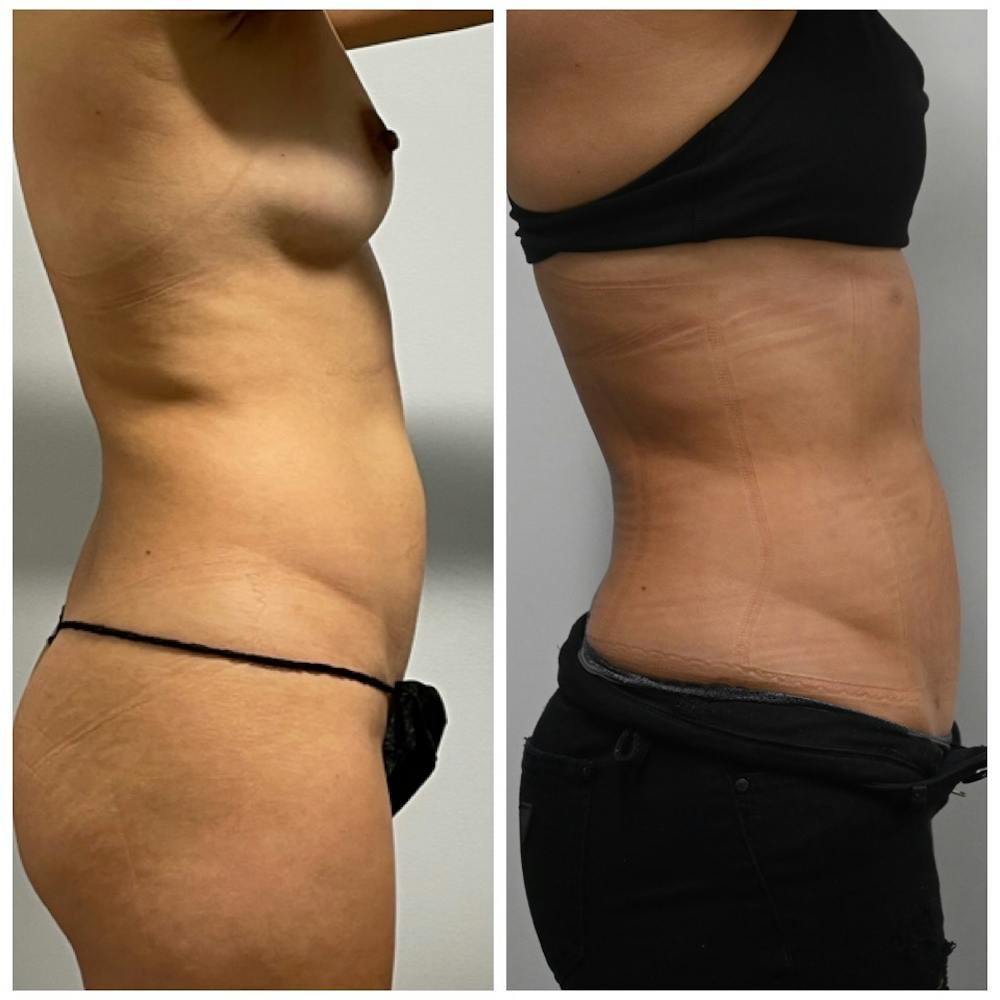 High-Def Liposuction  Before & After Photos - Patient 146287203 - Image 2