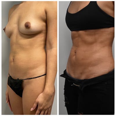 High-Def Liposuction  Before & After Photos - Patient 146287203 - Image 1