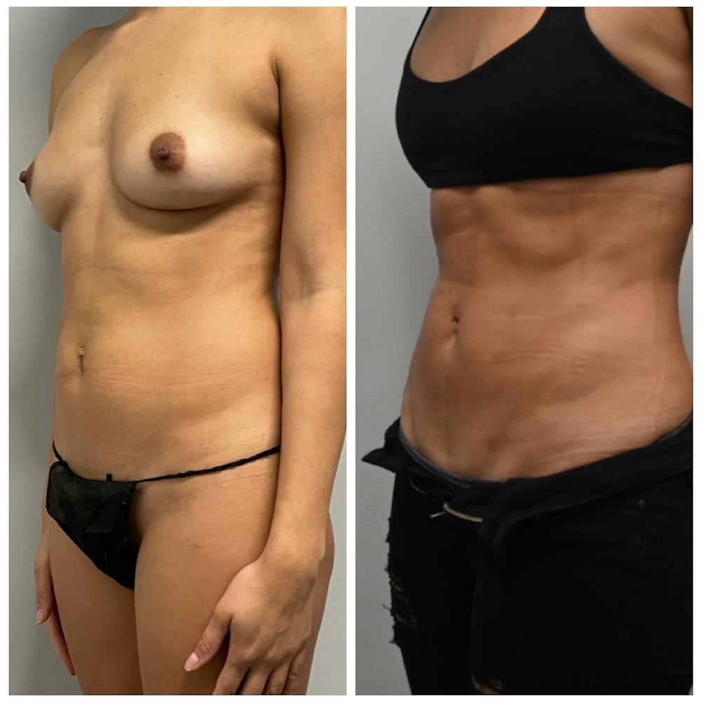 Lux Lipo Before & After Photos - Patient 118981 - Image 3