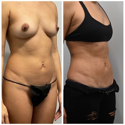 Lux Lipo Before & After Photos - Patient 118981 - Image 2