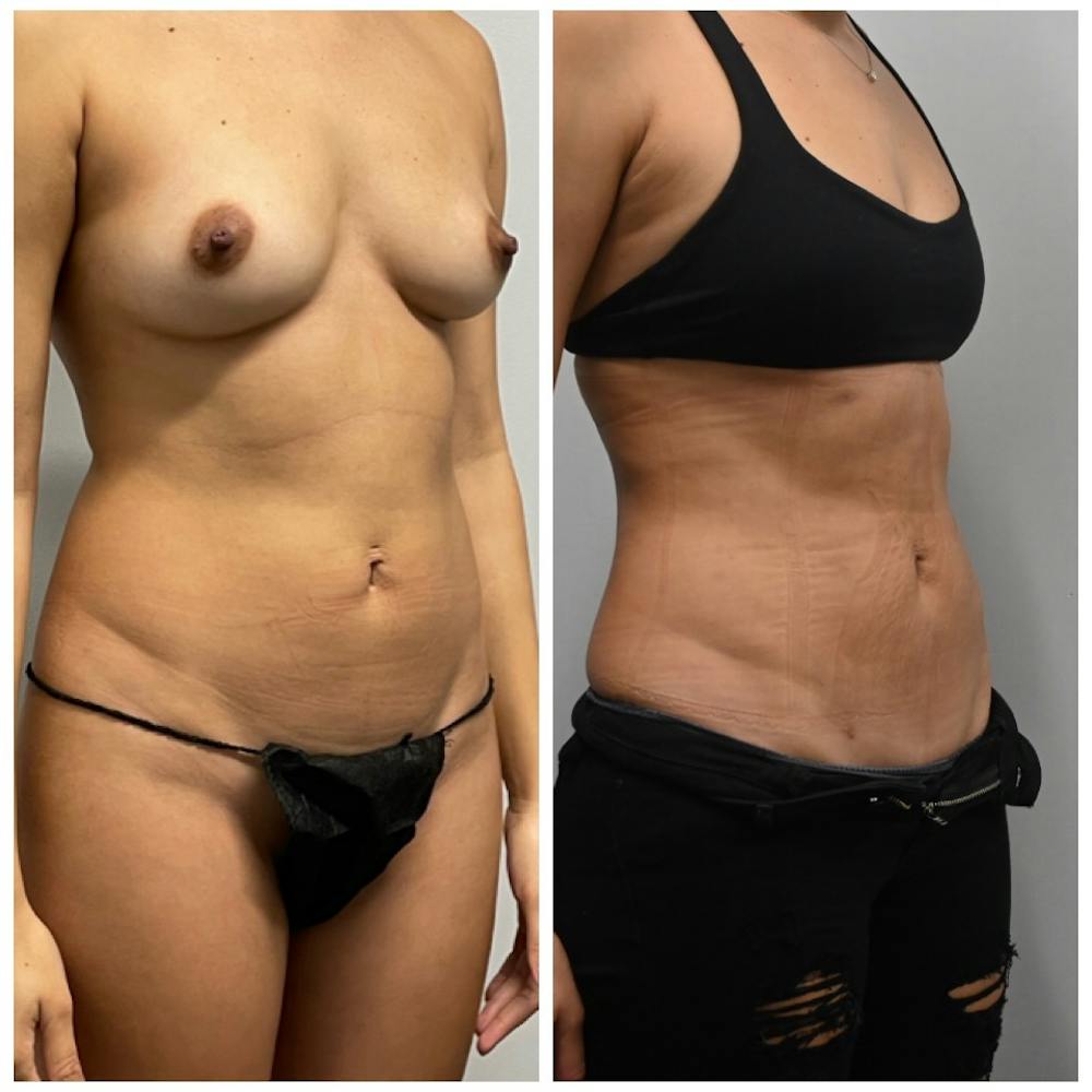 Lux Lipo Before & After Gallery - Patient 118981 - Image 2