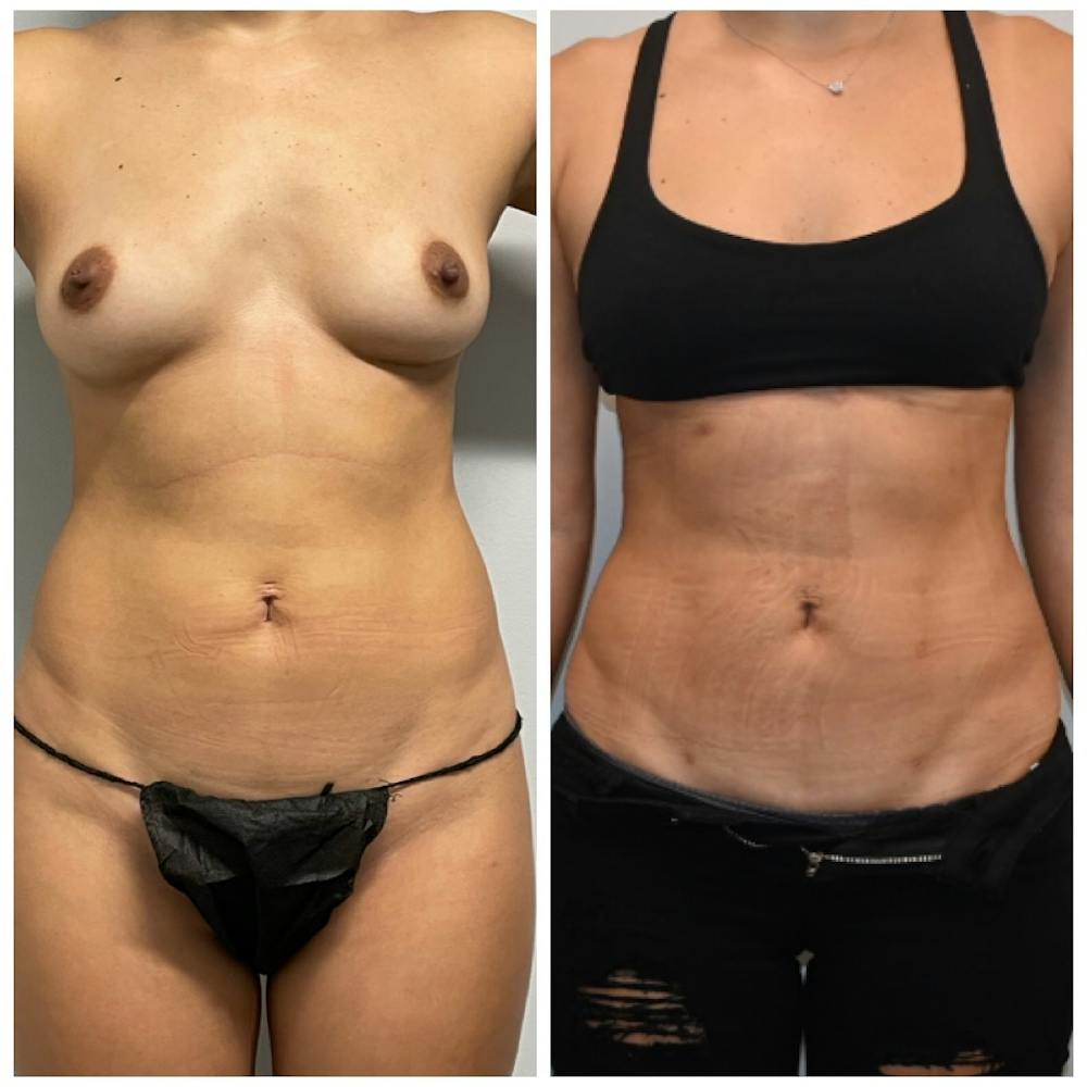 High-Def Liposuction  Before & After Photos - Patient 146287203 - Image 4