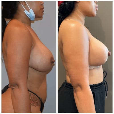 Breast Lift Before & After Gallery - Patient 146287204 - Image 2