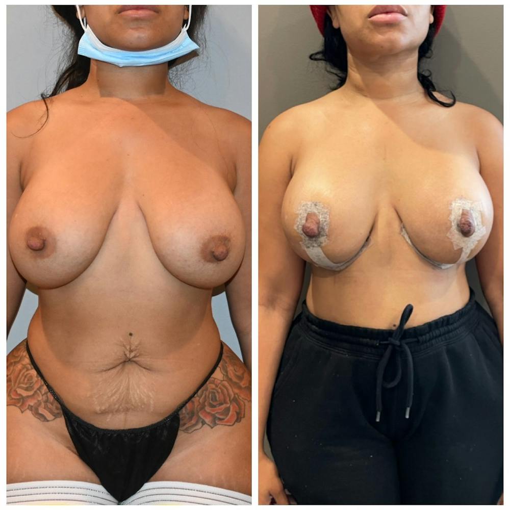 Breast Lift Before & After Gallery - Patient 146287204 - Image 1