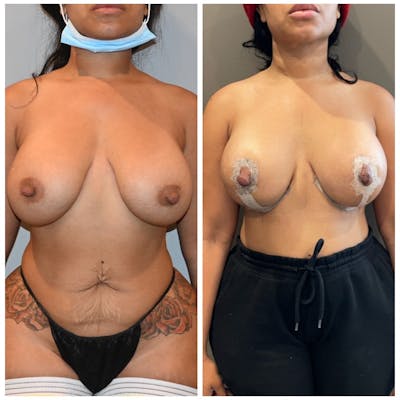 Breast Lift Before & After Gallery - Patient 146287204 - Image 1