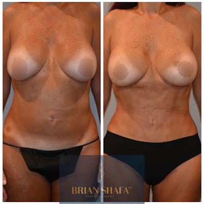 Reverse Tummy Tuck Before & After Gallery - Patient 146287372 - Image 1