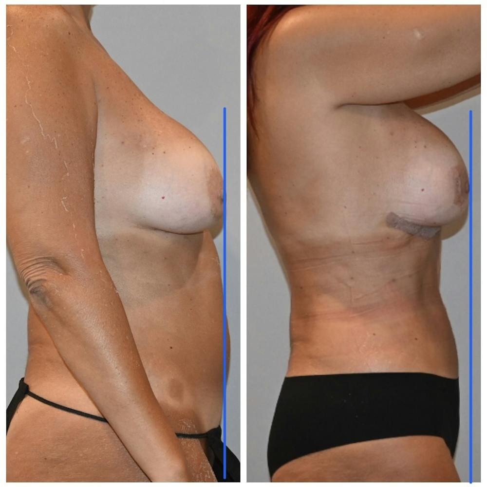 Reverse Tummy Tuck Before & After Gallery - Patient 146287372 - Image 2