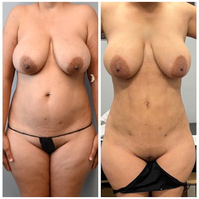 High-Def Liposuction  Before & After Photos - Patient 146287373 - Image 1