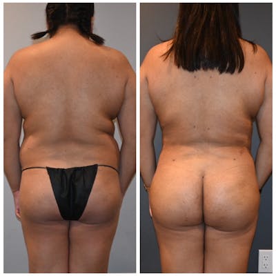 Brazilian Butt Lift Before & After Photos - Patient 146287377 - Image 1