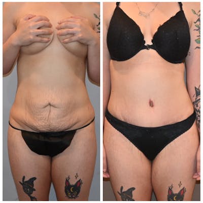 Tummy Tuck (Abdominoplasty) Before & After Photos - Patient 146287380 - Image 1
