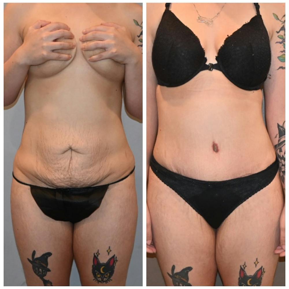 Tummy Tuck (Abdominoplasty) Before & After Gallery - Patient 146287380 - Image 1