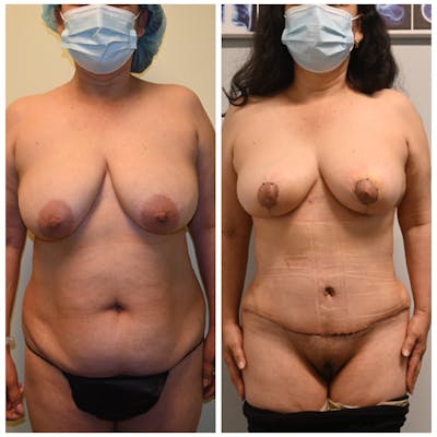 Mommy Makeover Before & After Gallery - Patient 146287385 - Image 1