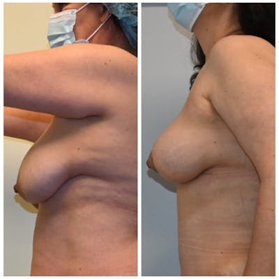 Breast Lift Before & After Photos - Patient 146287390 - Image 1