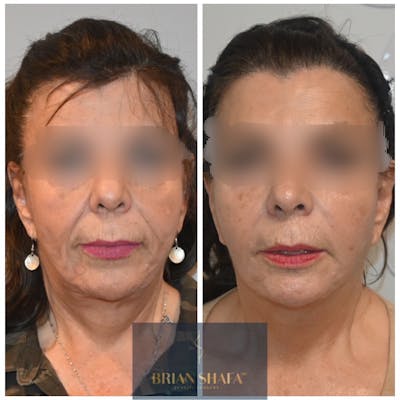 Facelift/Necklift Before & After Photos - Patient 122876245 - Image 1