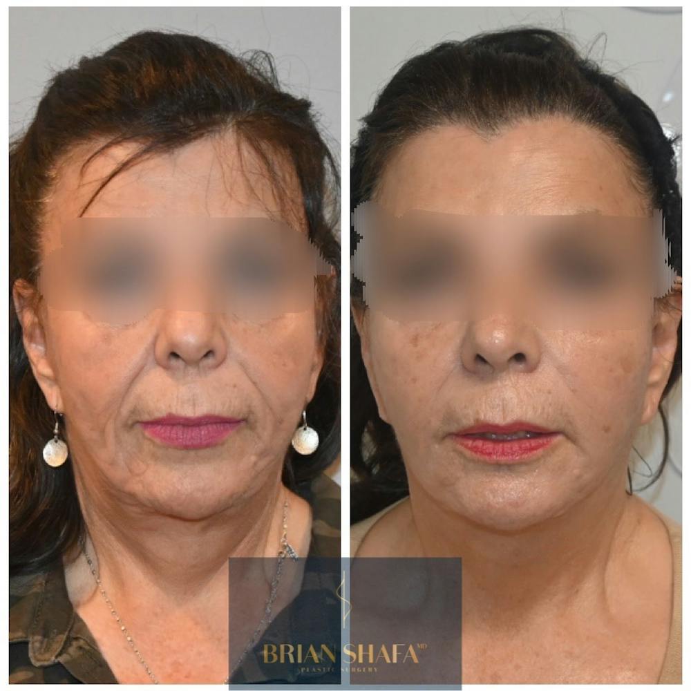 Facelift/Necklift Before & After Gallery - Patient 122876245 - Image 1